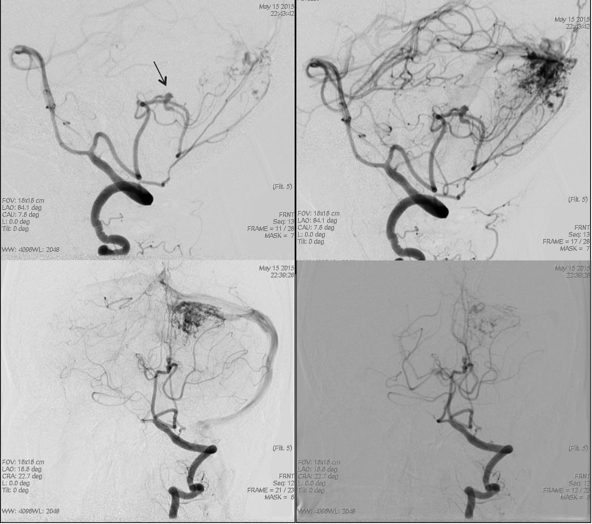 avm-with-pica-aneurysm